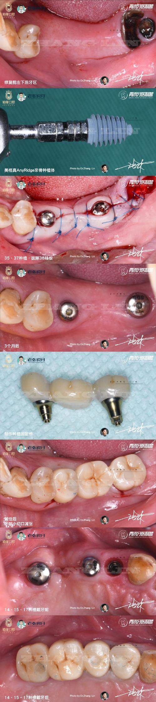 下半植牙如何固定-图3