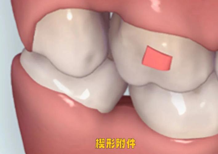 自己在家粘正畸附件-图1 自己在家粘正畸附件-图1