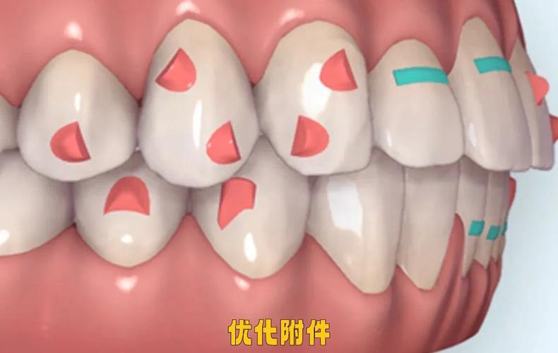 自己在家粘正畸附件-图2 自己在家粘正畸附件-图2