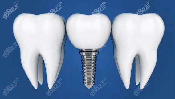 无锡植牙医院哪家好？专业医生资质怎么选？-图2