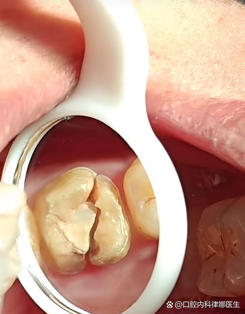 植牙打桩桩体松动-图3