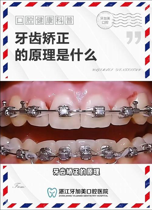 正畸托槽受力方向如何影响牙齿矫正效果？-图3