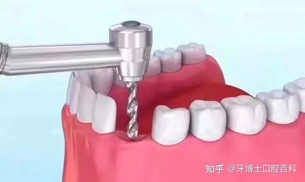 成都哪里植牙最好-图2