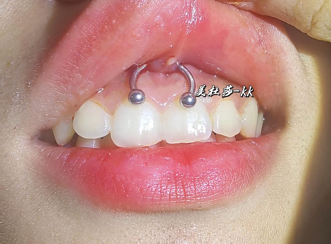 植牙的牙钉哪个好-图2 植牙的牙钉哪个好-图2