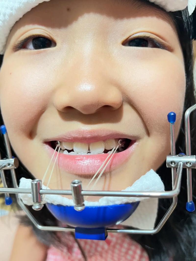 天津成年反颌正畸可行吗？效果与注意事项有哪些？-图1