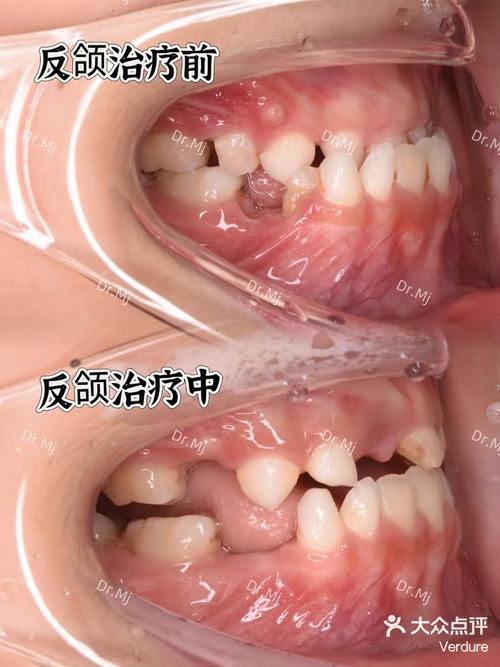 天津成年反颌正畸可行吗？效果与注意事项有哪些？-图2