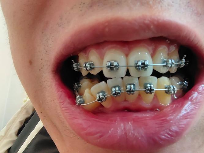 植牙后可以箍牙吗-图3