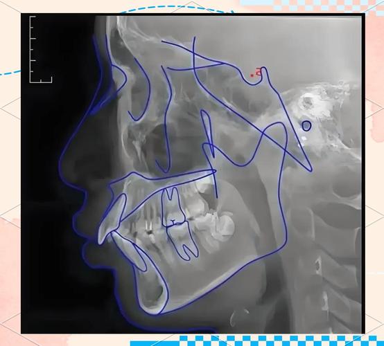 正畸SN MP角度-图3