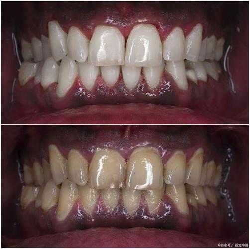 正畸后牙齿色素沉积，原因是什么？如何清除？-图1