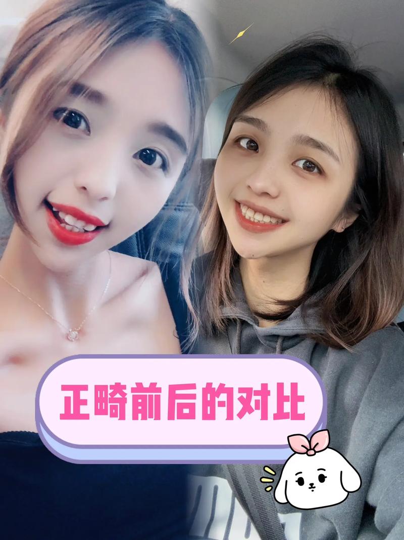 正畸矫正 前后对比-图3