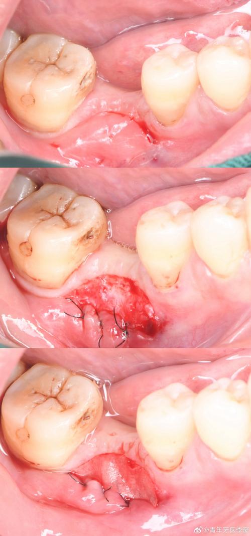 牙槽骨植骨粉手术-图1