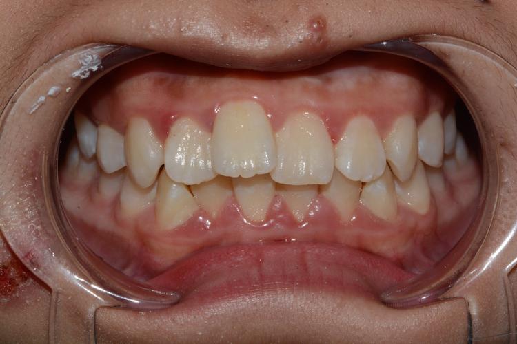 3wubegg正畸效果如何？适合哪些牙齿问题人群？-图3