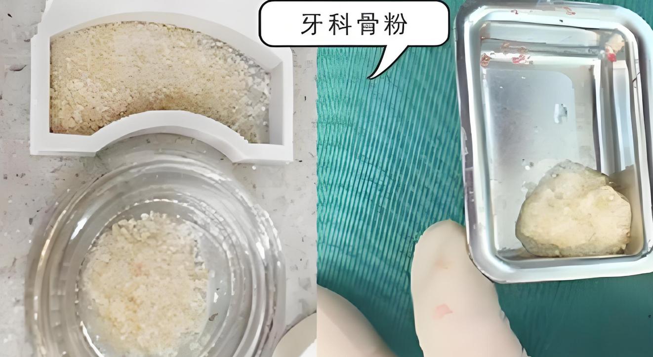 牙槽骨薄 植骨粉-图1