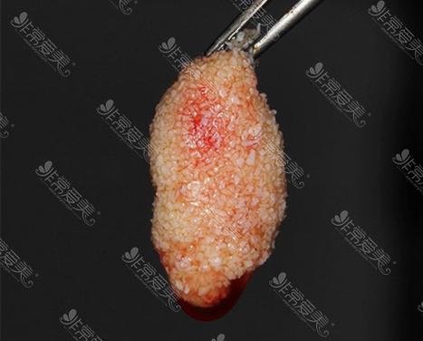 牙槽骨薄 植骨粉-图3