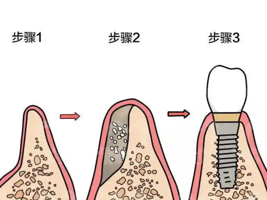 种植牙 不用植骨-图2