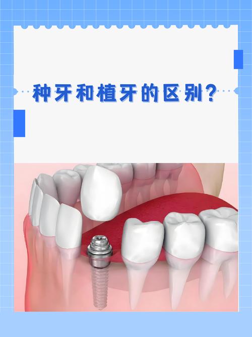 种牙与植牙，究竟有何本质区别？-图3
