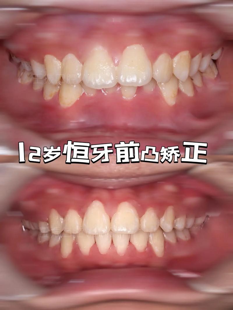 恒牙 24颗 正畸-图2 恒牙 24颗 正畸-图2