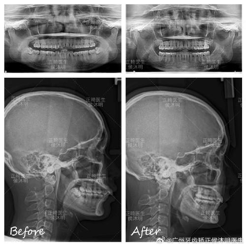 正畸中PP平面与MP平面有何临床意义?-图3 正畸中PP平面与MP平面有何临床意义?-图3