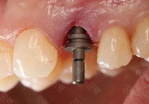 上海口腔医院植牙-图2 上海口腔医院植牙-图2