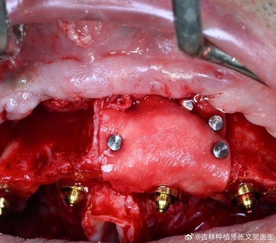种植牙植骨疼不疼？手术过程和术后疼痛情况如何？-图3