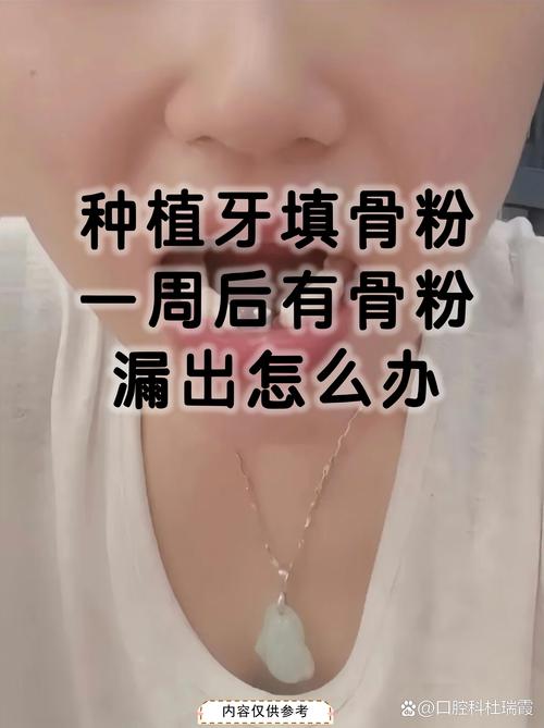 骨粉植牙失败,背后原因究竟是什么?-图1 骨粉植牙失败,背后原因究竟是什么?-图1