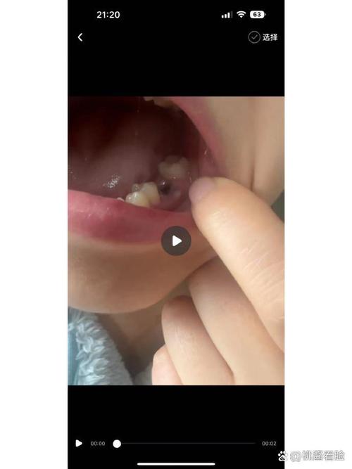 骨粉植牙失败,背后原因究竟是什么?-图2 骨粉植牙失败,背后原因究竟是什么?-图2