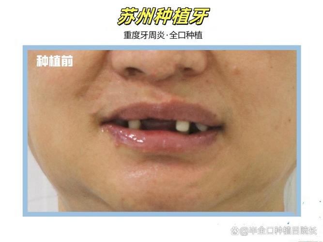 骨粉植牙失败,背后原因究竟是什么?-图3 骨粉植牙失败,背后原因究竟是什么?-图3