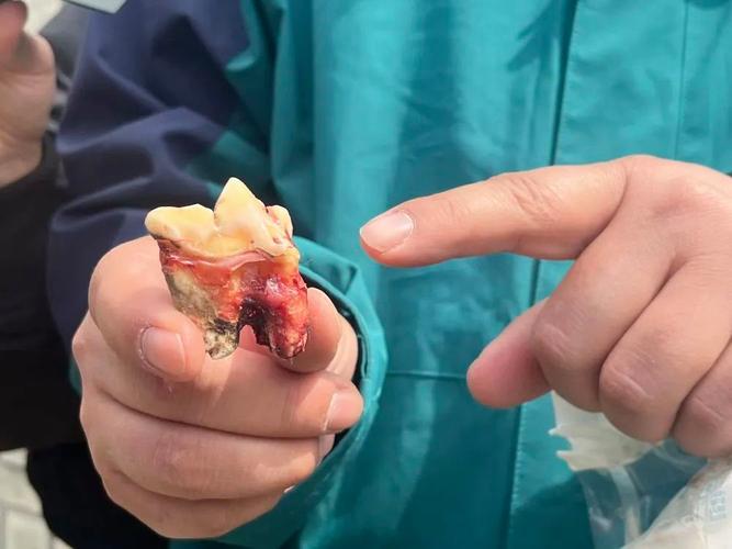 正畸拔虎牙真的有必要吗？会对牙齿和脸型有影响吗？-图1