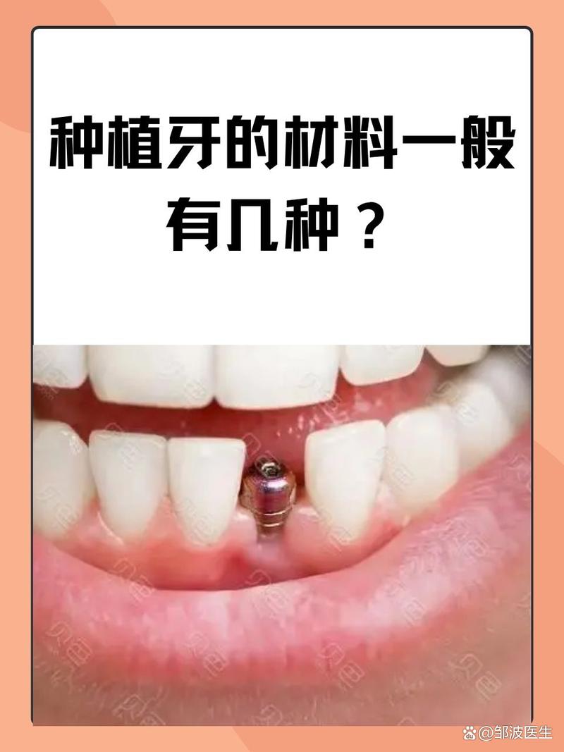 植牙材料有哪些？哪种更适合你？-图2
