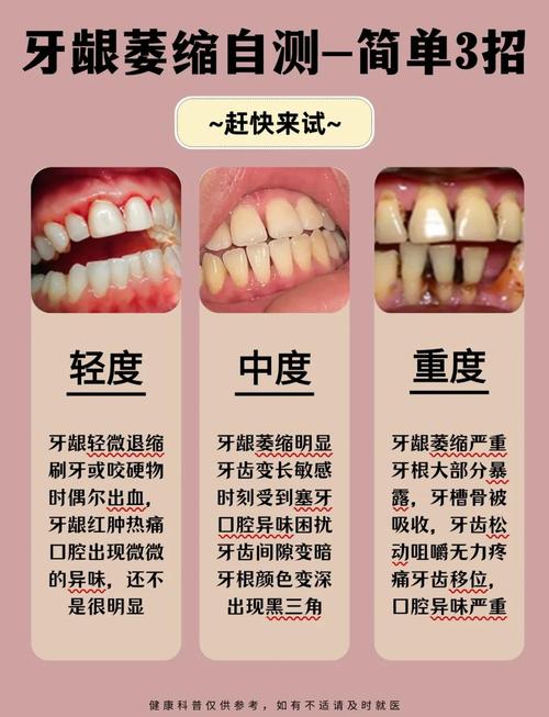 牙龈萎缩能植牙吗-图3 牙龈萎缩能植牙吗-图3