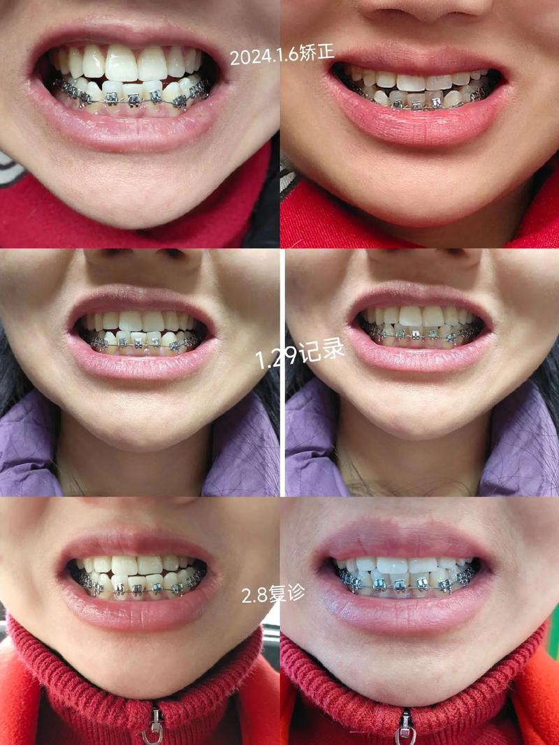 牙齿色素沉着 正畸-图2