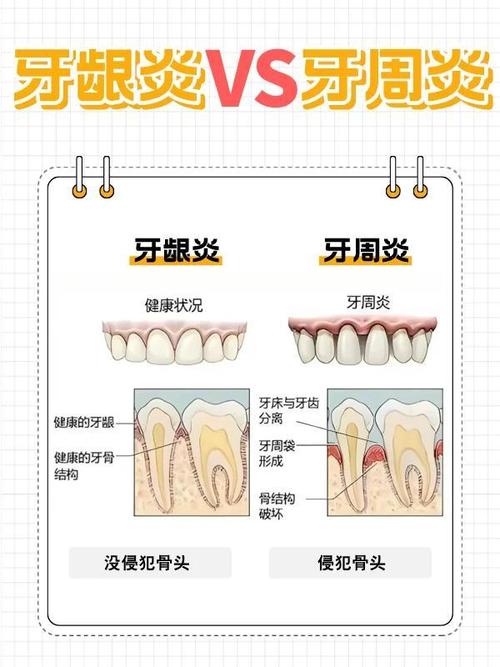 牙周炎正畸治疗，如何选择安全有效的方法？-图3