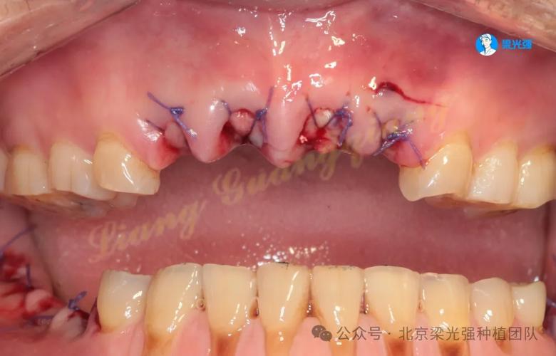 第一期植牙失败，究竟是什么原因？后续治疗该如何补救？-图2
