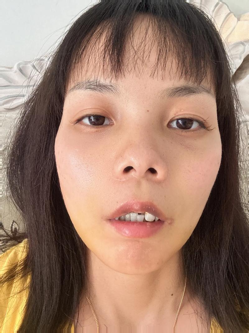 植完牙脸一直肿-图1 植完牙脸一直肿-图1