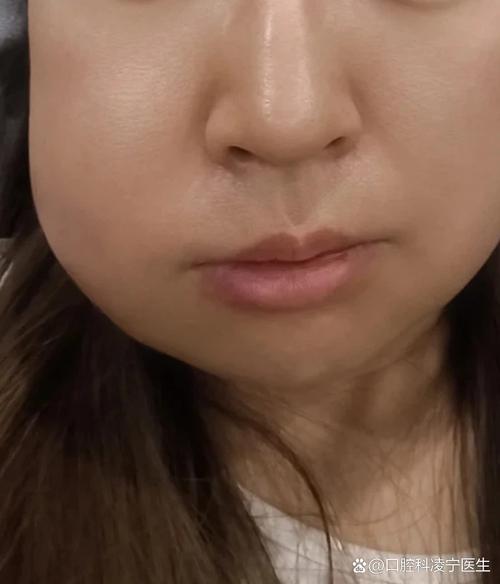 植完牙脸一直肿-图2 植完牙脸一直肿-图2