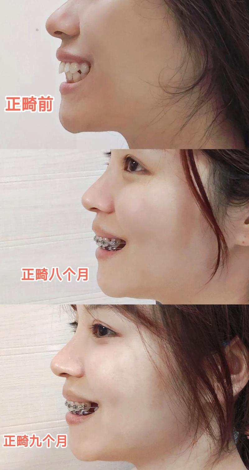 正畸调整中线 成功-图1