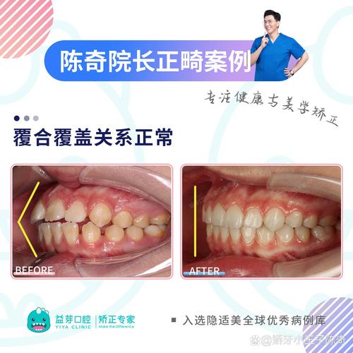 正畸调整中线 成功-图2