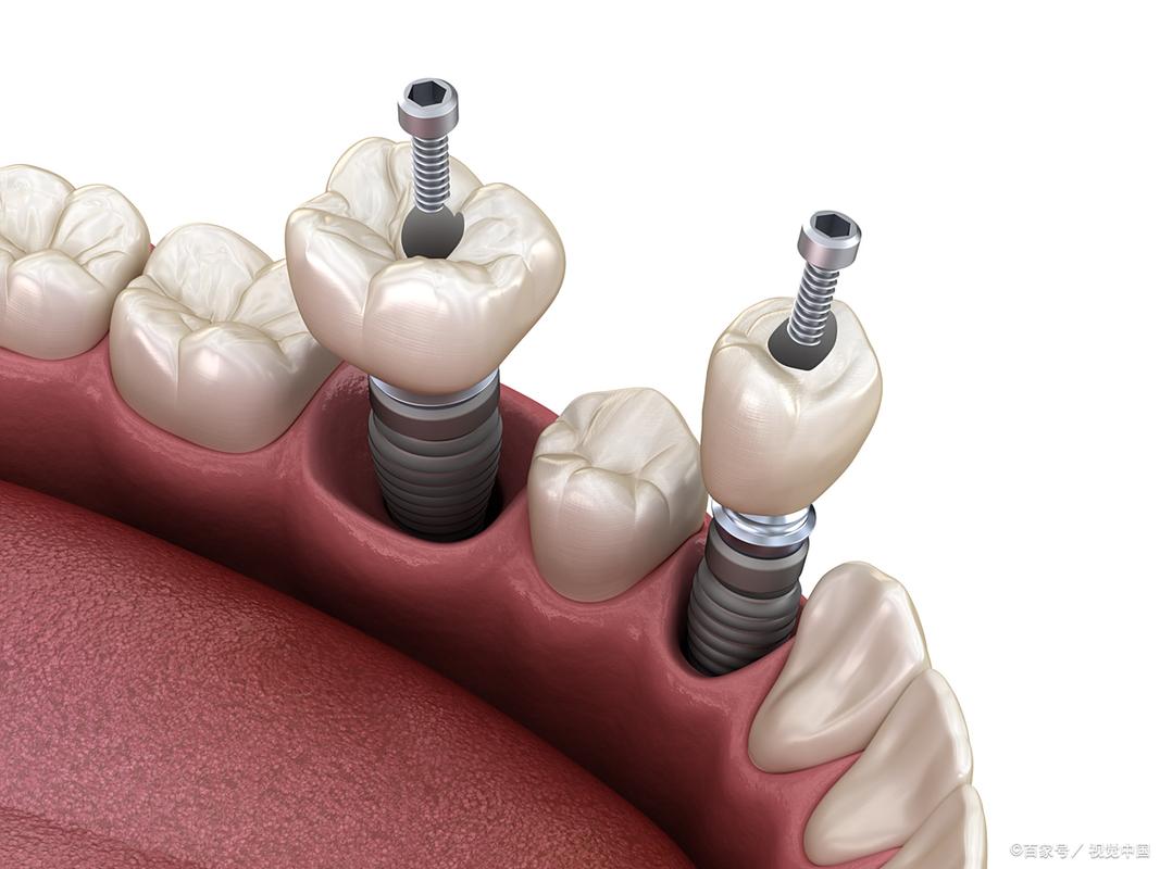 衡阳附二种植牙怎么样？价格和技术靠谱吗？-图3