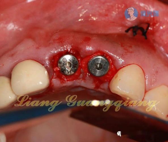 种牙植骨什么人-图2