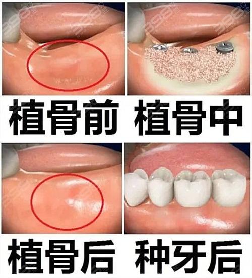 种牙植骨什么人-图3