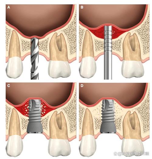牙槽骨外提植骨是什么？安全与效果如何？-图2