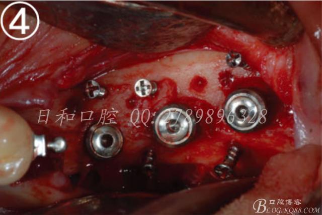 种牙植体后打钉-图1