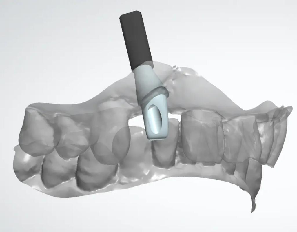 植牙个性化基台-图1