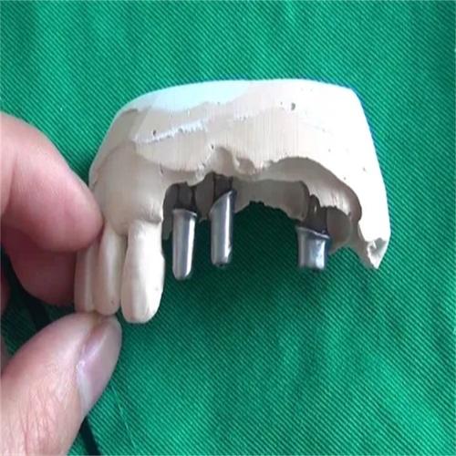 植牙个性化基台-图3