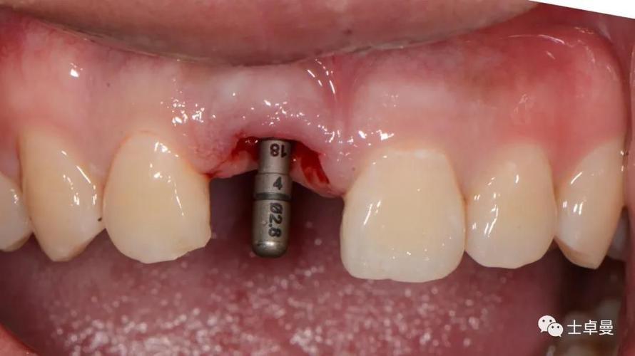 植牙个性化基台-图2