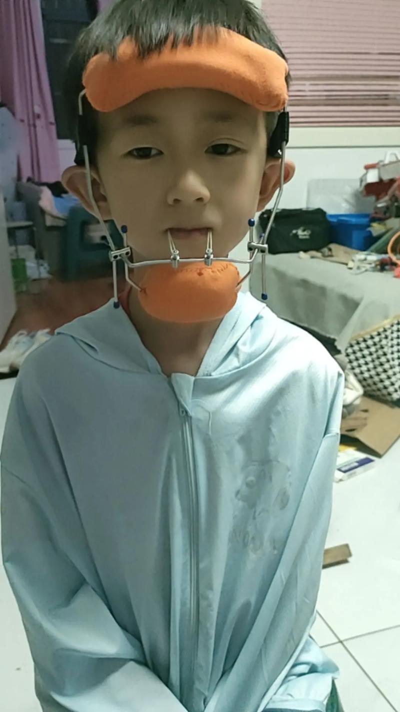 地包天 正畸 深圳-图1