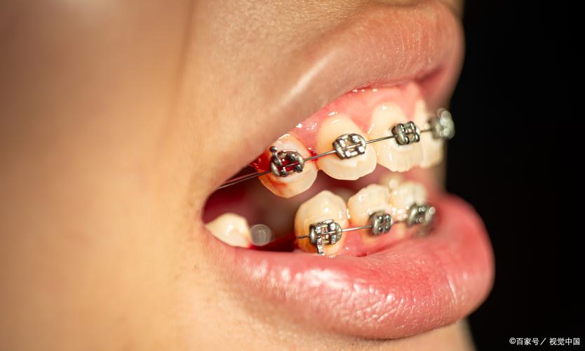 怀孕 牙齿正畸矫正-图2
