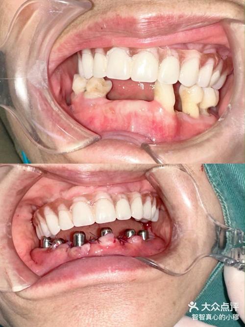 植骨种牙效果图-图1