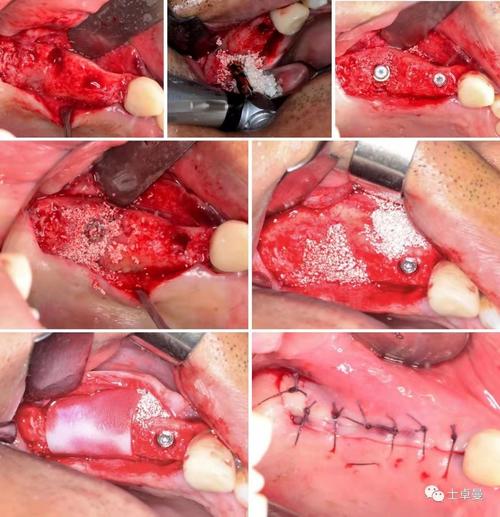 植骨种牙效果图-图2