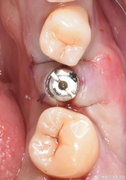 植骨种牙效果图-图3